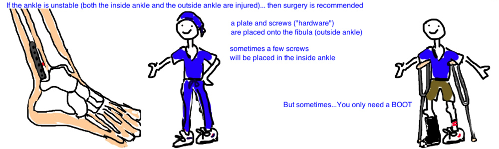 Why is it difficult to walk with a fractured fibula?